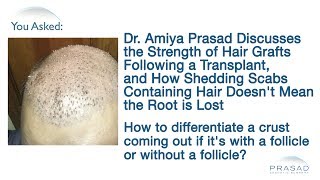 Why Dislodged Scabs Containing Hair After a Hair Transplant Doesnt Mean That Hair Grafts are Lost [upl. by Edlun94]