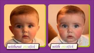 Otostick® Baby  Reduces prominent ears without surgery [upl. by Schlesinger]