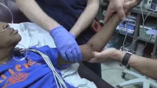 Posterior Elbow Dislocation Reduction [upl. by Einnos]