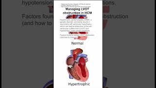 Managing left ventricular outflow tract LVOT obstruction in hypertrophic cardiomyopathy HCM [upl. by Hew]