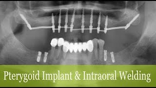 Pterygoid Implant amp Intraoral Welding [upl. by Aihtnamas306]