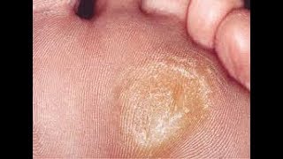 How to Drain a Blister Treatment amp Remedies [upl. by Yelhs169]