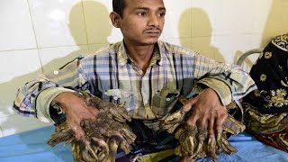 Ray of hope for “Tree Man” after 16 surgeries [upl. by Ordnaxela]