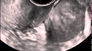 Ultrasound in Obstetrics amp Gynecology A Practical Approach  Clip 111 [upl. by Bedwell]