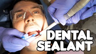 Dental Sealant Procedure [upl. by Sucramej]