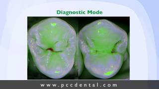 Ask Gordon caries detector for occlusal caries [upl. by Hiasi96]