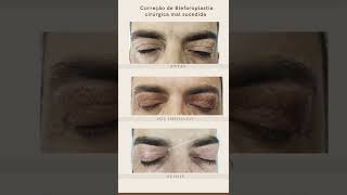 BLEFAROPLASTIA Jato Gerador Plasma Puro clinicaostteobell [upl. by Akit]