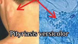 Pityriasis Versicolor under the microscope [upl. by Efioa]