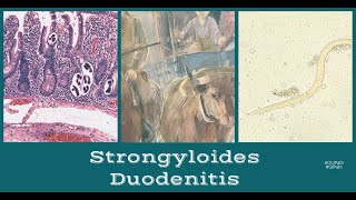 Strongyloides Duodenitis [upl. by Aleirbag]