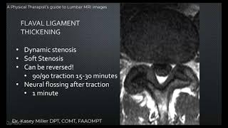 Flaval ligament thickening by Dr Kasey Miller DPT COMT FAAOMPT [upl. by Saul]