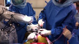 Total Hip Replacement Using MAKO Robotic Assistance [upl. by Toshiko599]