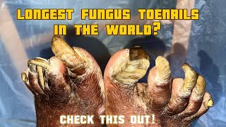 Extremely fungal thickened toenails I Onychogryphosis Transformation Trust Your Podiatrist [upl. by Deutsch]