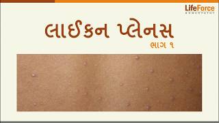 What should you know about Lichen Planus treatment Gujarati  Part 12 [upl. by Jorie377]