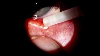 Meibomian cyst expressed [upl. by Cchaddie]