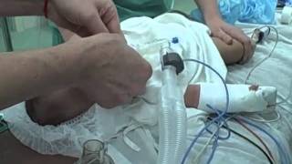 Pediatric Glidescope in Infants with LTA Stylet [upl. by Llorre784]