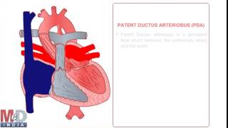 Patent Ductus Arteriosus [upl. by Merlina]