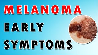 Melanoma Skin Cancer [upl. by Oranneg]