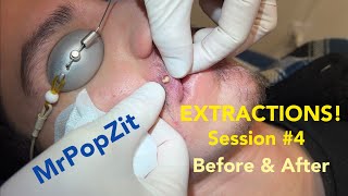 Severe Acne extractions Session 4 amazing before and after So many pops [upl. by Aranat]