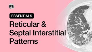 Reticular amp Septal Interstitial Opacities  Chest Radiology Essentials [upl. by Nolasba]