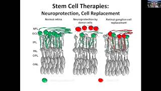 Regeneration and stem cell transplantation as treatment for optic neuropathies [upl. by Hsaniva]