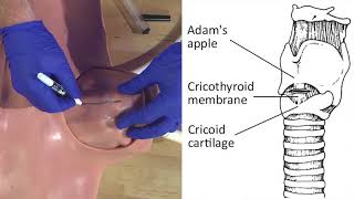 Emergency Needle Cricothyrotomy Procedure Explained [upl. by Hardy]