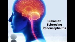 Subacute sclerosing panencephalitis SSPE [upl. by Snell938]