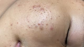 ACNE TREATMENT VU QUYNH MI Acne On Boys Chin 2024 [upl. by Jilli]