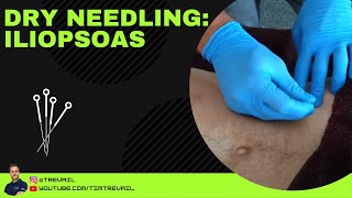 Dry Needling Iliopsoas [upl. by Ause]