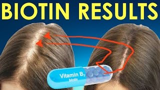 BIOTIN HAIR GROWTH RESULTS before and after  BIOTIN RESULTS for hair regrowth and hair loss [upl. by Habeh22]