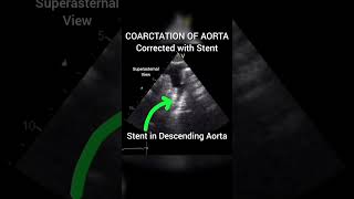 Coarctation Of Aorta corrected with Stent echocardiography for Beginners cardiology echo [upl. by Attennod]