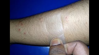 Diascopy Or Glass Test  Differentiate Erythematous or PurpuricPetichial lesion [upl. by Ajuna288]