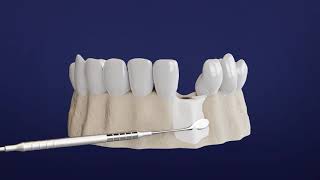 How Dentists Insert Dental Implants [upl. by Reinhold]