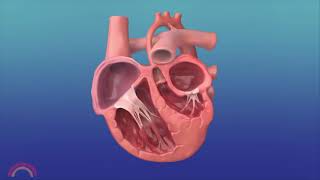 InUtero Procedure to Reverse Hypoplastic Left Heart Syndrome [upl. by Romanas]