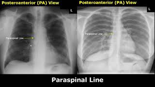 Normal Chest XRay Labelled Anatomy PA View Part 2 CXR Interpretation  Mediastinum Radiography [upl. by Akinom]