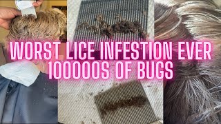 1 Yr Lice Infestation l Worst Lice Infestation Ever 😱 l 2 12 Hr Head Lice Treatment [upl. by Norat]