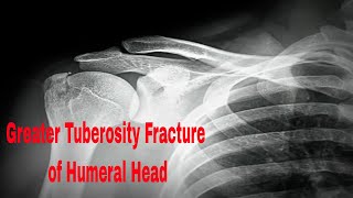 Breaking Right Shoulders Greater Tuberosity [upl. by Nairrod]