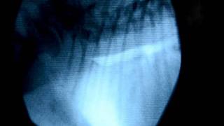 Colapso traqueal fluoroscopia y endoscopia [upl. by Zorine]