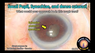 CataractCoach™ 1879 small pupil synechiae and dense cataract [upl. by Saxela675]