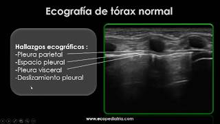 Ecografía de Derrame Pleural [upl. by Iloj]