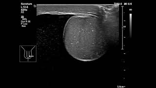 testicle microcalcification [upl. by Ridglee]