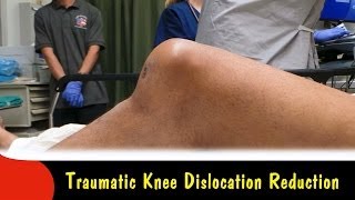 Traumatic Knee Dislocation ReductionQuick Version [upl. by Tansy616]