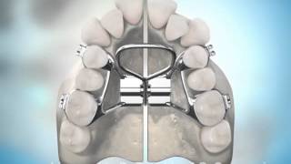 Surgically Assisted Palatal Expansion [upl. by Hausner636]