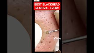 Best BLACKHEAD REMOVAL Ever  So Satisfying shorts [upl. by Richard]