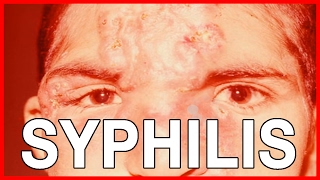 Signs and Symptoms of Syphilis Types of Syphilis and Treatment [upl. by Amber581]