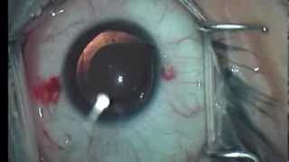 Visian ICL Implantation [upl. by Jay626]