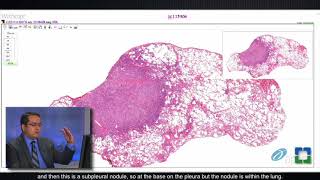 Lung Granulomas Caused by Fungal Infection [upl. by Eselahs]