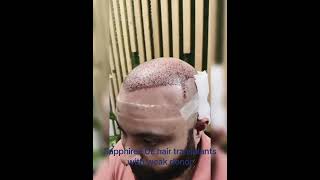 Sapphire FUE hair transplant pakistan dhihairtransplantation hairtransplantation [upl. by Olegna]