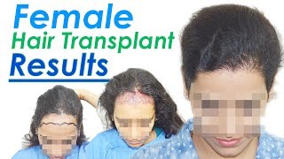 Best Female Hair Transplant  Fabulous Natural Hairline  MEDISPA INDIA  Dr Suneet  USA  UAE  UK [upl. by Verne]