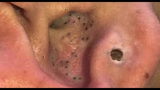 Removing huge blackhead from ears Satisfying Blackhead 2021 Short easy makeup hacks [upl. by Rabassa]