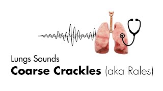 Coarse Crackles Rales  Lung Sounds  Medzcool [upl. by Latisha]